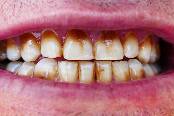 Prevents tooth decay and stains